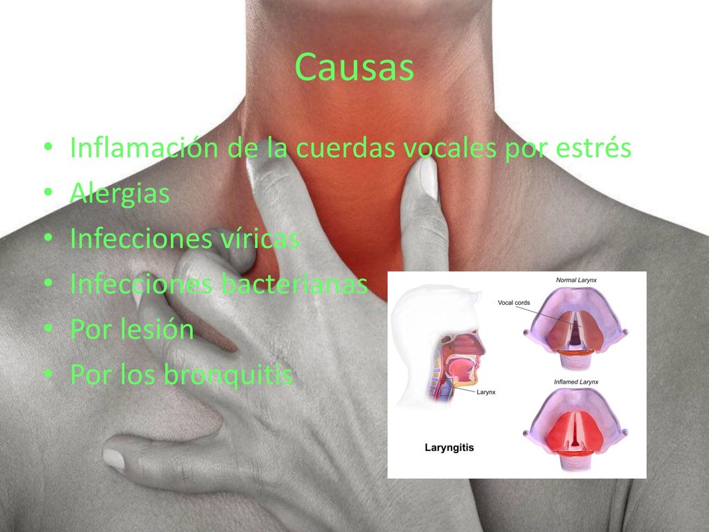 remedios caseros para inflamacion de las cuerdas vocales